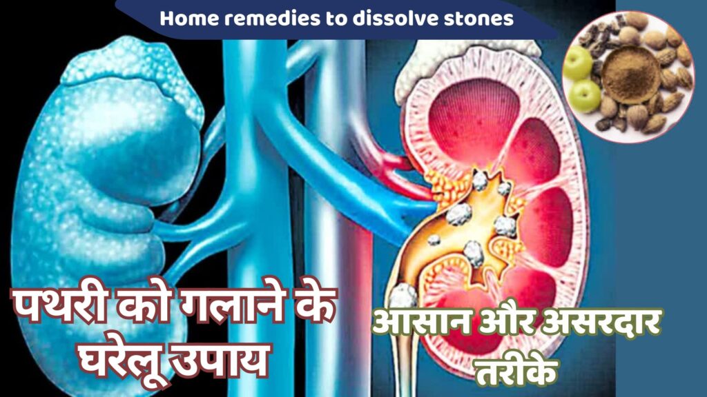 पथरी को गलाने के उपाय आसान और असरदार तरीके 10 Best Remedies for Dissolving Stones